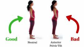 假翹臂是盤骨前傾其中一個表徵，盤骨前傾(Anterior pelvic tilt)是常見的病患情況，不分性別，年齡或職業，都有機會有患上盤骨前傾。